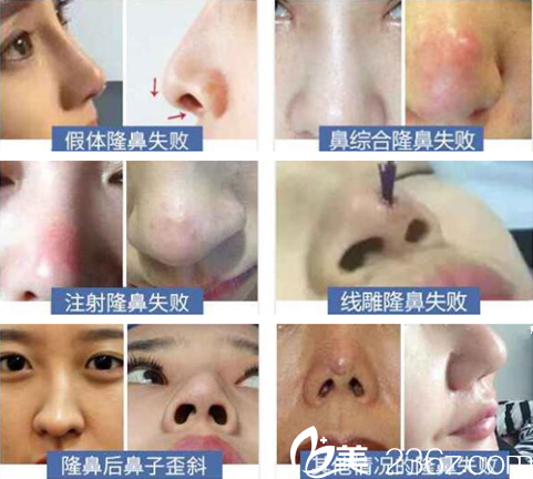 各種不同情況的隆鼻失敗現(xiàn)象
