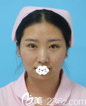 到咸陽公立醫(yī)院<i data-id='0fc1f97a-7e81-4446-b20d-c7f56a37e144' style='display:none;'></i>整形科做雙眼皮效果