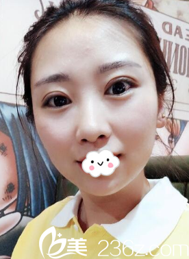 護(hù)士到美容科割雙眼皮變化太大 看王埴鋮韓式定點(diǎn)雙眼皮效果圖！