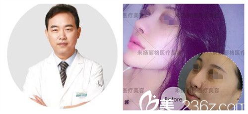 北京米揚(yáng)麗格巫文云隆鼻案例