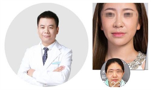 北京米揚(yáng)麗格夏正義隆鼻案例