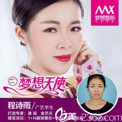 南寧夢(mèng)想整形醫(yī)院唐超院長(zhǎng)做的雙眼皮案例