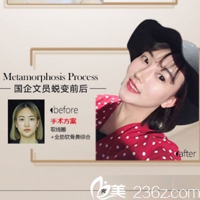 南寧夢(mèng)想唐超院長(zhǎng)做的全肋軟骨鼻綜合隆鼻案例