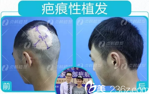南寧貞韓植發(fā)做疤痕性植發(fā)效果圖