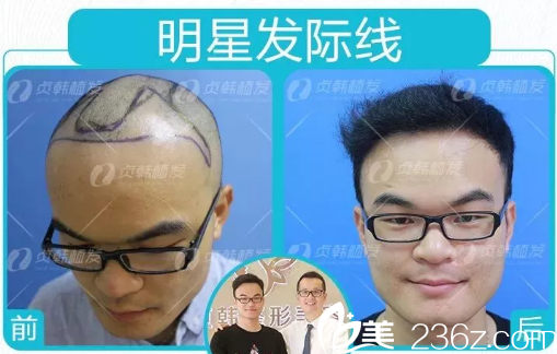 南寧貞韓植發(fā)醫(yī)院做發(fā)際線種植的效果圖