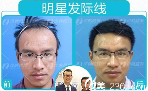 管老師在南寧貞韓植發(fā)醫(yī)院做發(fā)際線種植的經(jīng)歷分享