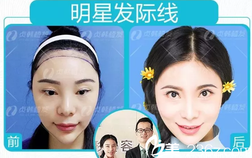 娜拉在南寧貞韓植發(fā)醫(yī)院做發(fā)際線種植效果圖