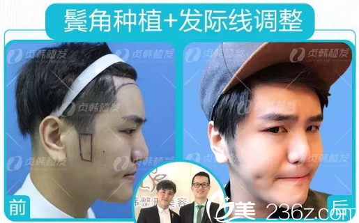 小賢在南寧貞韓植發(fā)醫(yī)院做鬢角種植效果圖