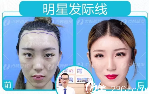 糖糖在南寧貞韓植發(fā)醫(yī)院做發(fā)際線種植術(shù)后效果圖