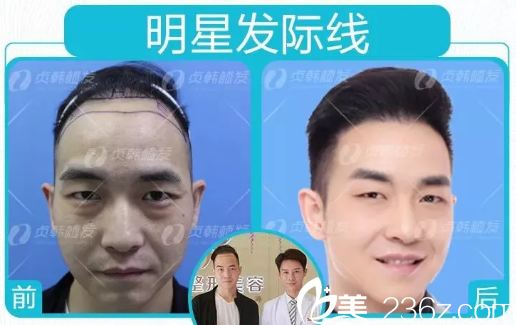 周先生在南寧貞韓植發(fā)醫(yī)院做發(fā)際線種植的真實反饋