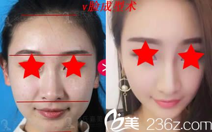 楚雄吳氏嘉美整形美容醫(yī)院面部輪廓效果對(duì)比圖