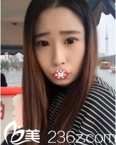 術(shù)前我的下巴很短 術(shù)前我的下巴很短