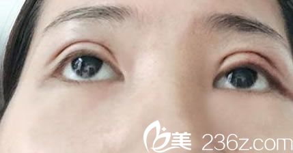做完雙眼皮手術(shù)的照片