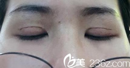 7天拆完線疤痕恢復(fù)情況