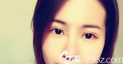 自從找金華玥萊美孫喜平做雙眼皮手術(shù)效果恢復(fù)好后，朋友圈照片點贊的人超級多