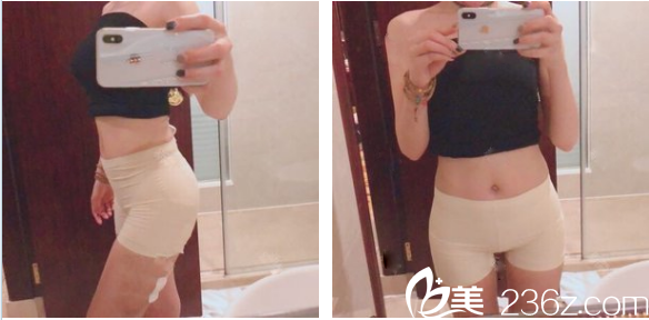 在昆明韓辰整形醫(yī)院做完幸福吸脂術(shù)后四天