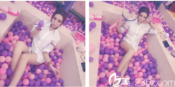 昆明韓辰做360幸福吸脂案例效果怎么樣