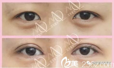 沈陽孟強醫(yī)療美容整形雙眼皮開眼角真人前后對比案例