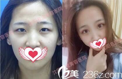 沈陽名流醫(yī)療美容董紅星雙眼皮真人前后對比案例