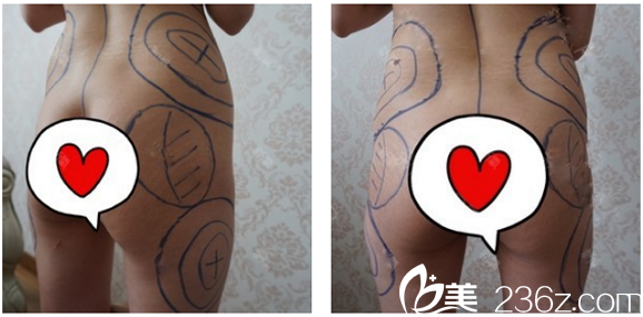 在昆明韓辰做幸福吸脂手術(shù)前