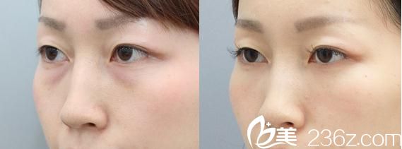 去眼袋手術(shù) 去眼袋手術(shù)