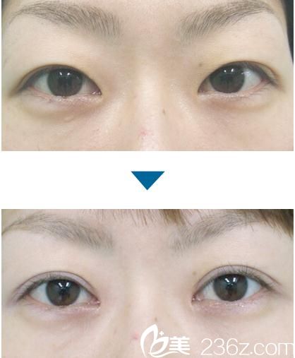 雙眼皮手術(shù)