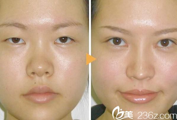 隆鼻術(shù) 隆鼻術(shù)