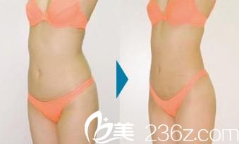 吸脂手術(shù) 吸脂手術(shù)