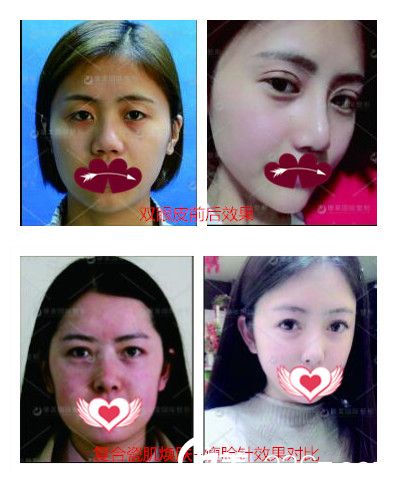 蘇州康美整形雙眼皮案例及瘦臉案例效果對比