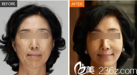 楚雄吳氏嘉美整形美容白孝梅面部年輕化效果對(duì)比圖 楚雄吳氏嘉美整形美容白孝梅面部年輕化效果對(duì)比圖