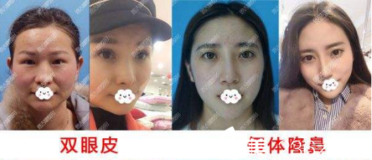 隨州奧萊雙眼皮、隆鼻整形真人案例