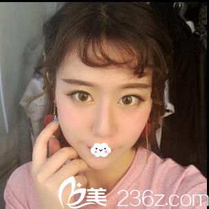 隨州隆鼻哪家好？隨州奧萊<!--<i data=20240703-sp></i>-->假體隆鼻真人案例