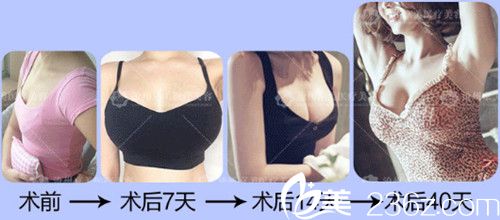 提曉華院長(zhǎng)自體脂肪豐胸案例