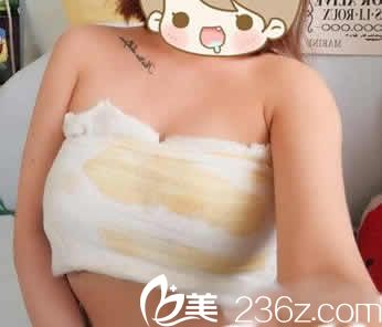 我在聊城韓美整形做假體隆胸術(shù)后第3天照片 我在聊城韓美整形做假體隆胸術(shù)后第3天照片