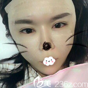 昆明韓辰自體脂肪填充效果怎么樣？王德寧脂肪移植案例效果