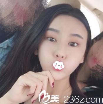 昆明韓辰王德寧脂肪填充太陽(yáng)穴+額頭案例