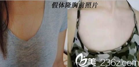 楚雄吳氏嘉美整形假體隆胸前照片 楚雄吳氏嘉美整形假體隆胸前照片