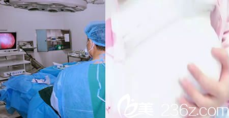 楚雄吳氏嘉美整形醫(yī)院內(nèi)窺鏡假體隆胸術(shù)中圖 楚雄吳氏嘉美整形醫(yī)院內(nèi)窺鏡假體隆胸術(shù)中圖