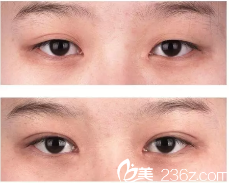 深圳美萊尹度龍做的埋線雙眼皮修復(fù)案例 深圳美萊尹度龍做的埋線雙眼皮修復(fù)案例