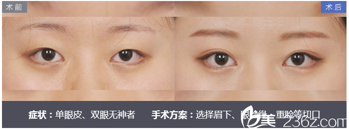 深圳美萊尹度龍做的雙眼皮案例 深圳美萊尹度龍做的雙眼皮案例