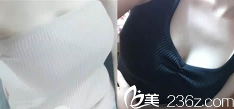 楚雄吳氏嘉美曼托假體隆胸術(shù)后15天照 楚雄吳氏嘉美曼托假體隆胸術(shù)后15天照