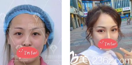 沈陽(yáng)杏林整形美容醫(yī)院埋線雙眼皮真人案例