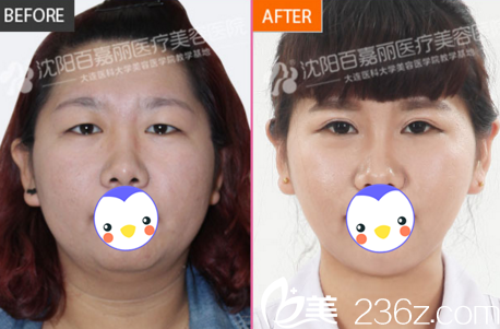 沈陽(yáng)百嘉麗整形醫(yī)院雙眼皮真人案例