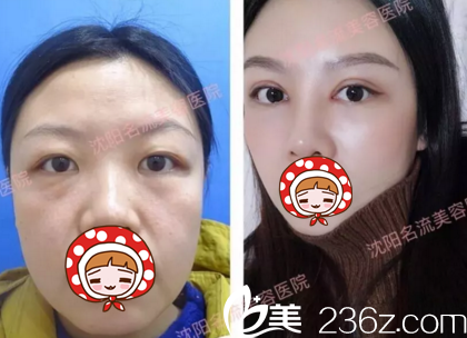 沈陽(yáng)名流醫(yī)療美容整形醫(yī)院雙眼皮真人案例展示