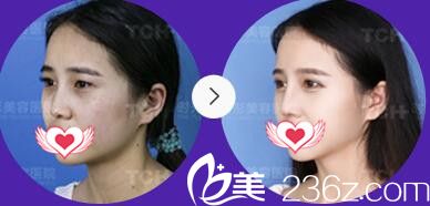 重慶時(shí)光整形醫(yī)院眼綜合+鼻綜合案例效果