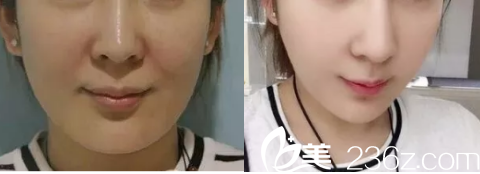 李在郁面部埋線提升案例