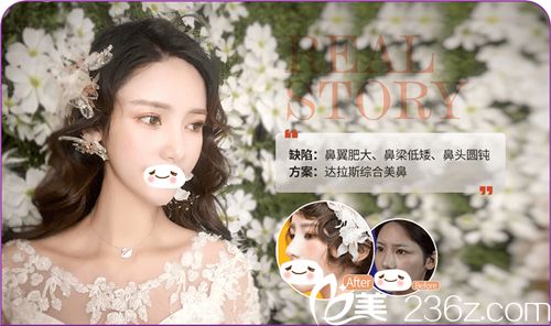 達(dá)拉斯鼻綜合案例