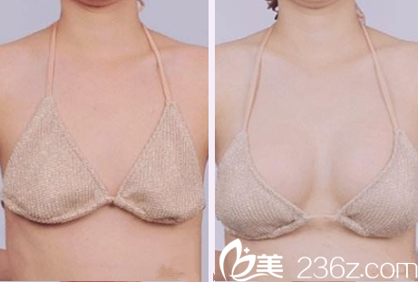隆胸前后對比