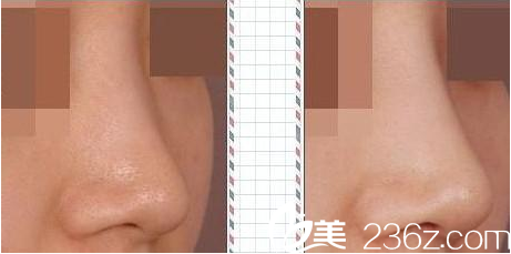 隆鼻前后對比圖