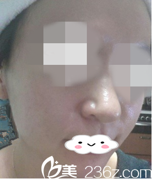 接受光子嫩膚二次治療的我